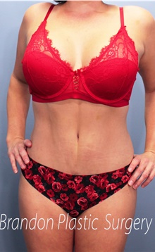 Tummy Tuck After Photo by Marvin Shienbaum, MD; Brandon, FL - Case 45874