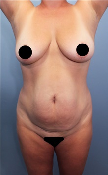 Tummy Tuck Before Photo by Marvin Shienbaum, MD; Brandon, FL - Case 45874