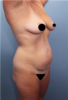 Tummy Tuck Before Photo by Marvin Shienbaum, MD; Brandon, FL - Case 45874