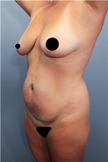 Tummy Tuck Before Photo by Marvin Shienbaum, MD; Brandon, FL - Case 45874