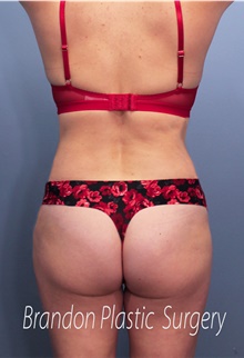 Tummy Tuck After Photo by Marvin Shienbaum, MD; Brandon, FL - Case 45874