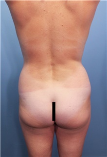 Tummy Tuck Before Photo by Marvin Shienbaum, MD; Brandon, FL - Case 45874