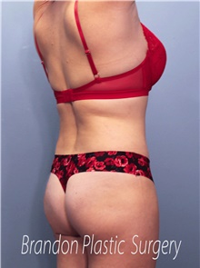 Tummy Tuck After Photo by Marvin Shienbaum, MD; Brandon, FL - Case 45874