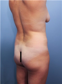 Tummy Tuck Before Photo by Marvin Shienbaum, MD; Brandon, FL - Case 45874