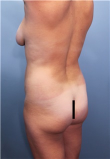 Tummy Tuck Before Photo by Marvin Shienbaum, MD; Brandon, FL - Case 45874