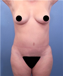 Tummy Tuck Before Photo by Marvin Shienbaum, MD; Brandon, FL - Case 45984