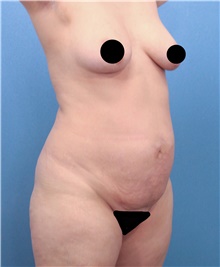 Tummy Tuck Before Photo by Marvin Shienbaum, MD; Brandon, FL - Case 45984