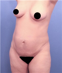 Tummy Tuck Before Photo by Marvin Shienbaum, MD; Brandon, FL - Case 45984