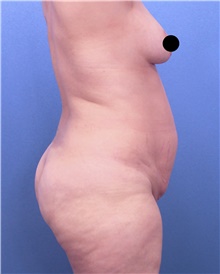 Tummy Tuck Before Photo by Marvin Shienbaum, MD; Brandon, FL - Case 45984