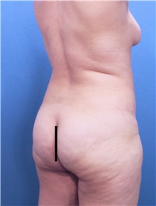 Tummy Tuck Before Photo by Marvin Shienbaum, MD; Brandon, FL - Case 45984