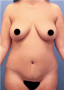 Tummy Tuck Before Photo by Marvin Shienbaum, MD; Brandon, FL - Case 45993