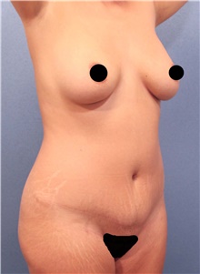 Tummy Tuck Before Photo by Marvin Shienbaum, MD; Brandon, FL - Case 45993