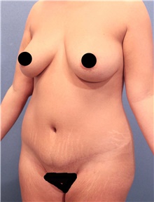 Tummy Tuck Before Photo by Marvin Shienbaum, MD; Brandon, FL - Case 45993