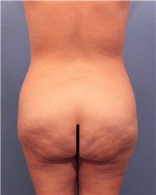 Tummy Tuck Before Photo by Marvin Shienbaum, MD; Brandon, FL - Case 45993