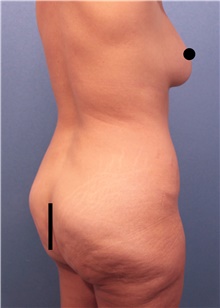 Tummy Tuck Before Photo by Marvin Shienbaum, MD; Brandon, FL - Case 45993