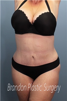 Tummy Tuck After Photo by Marvin Shienbaum, MD; Brandon, FL - Case 45994