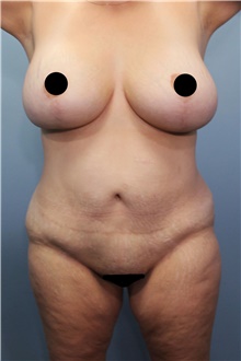 Tummy Tuck Before Photo by Marvin Shienbaum, MD; Brandon, FL - Case 45994