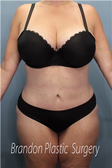 Tummy Tuck After Photo by Marvin Shienbaum, MD; Brandon, FL - Case 45994