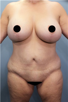 Tummy Tuck Before Photo by Marvin Shienbaum, MD; Brandon, FL - Case 45994