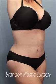 Tummy Tuck After Photo by Marvin Shienbaum, MD; Brandon, FL - Case 45994