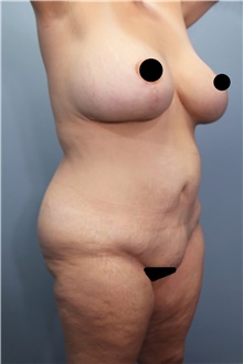 Tummy Tuck Before Photo by Marvin Shienbaum, MD; Brandon, FL - Case 45994