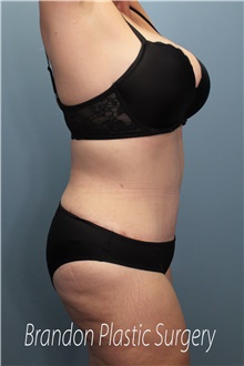 Tummy Tuck After Photo by Marvin Shienbaum, MD; Brandon, FL - Case 45994