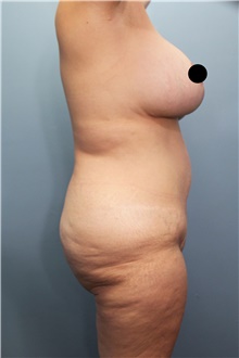 Tummy Tuck Before Photo by Marvin Shienbaum, MD; Brandon, FL - Case 45994