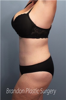 Tummy Tuck After Photo by Marvin Shienbaum, MD; Brandon, FL - Case 45994