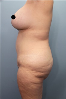 Tummy Tuck Before Photo by Marvin Shienbaum, MD; Brandon, FL - Case 45994