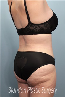 Tummy Tuck After Photo by Marvin Shienbaum, MD; Brandon, FL - Case 45994