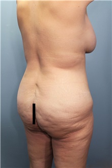 Tummy Tuck Before Photo by Marvin Shienbaum, MD; Brandon, FL - Case 45994