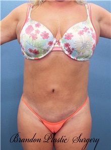 Tummy Tuck After Photo by Marvin Shienbaum, MD; Brandon, FL - Case 46024