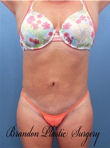 Tummy Tuck After Photo by Marvin Shienbaum, MD; Brandon, FL - Case 46024