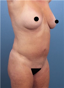 Tummy Tuck Before Photo by Marvin Shienbaum, MD; Brandon, FL - Case 46024