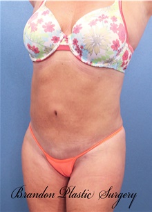 Tummy Tuck After Photo by Marvin Shienbaum, MD; Brandon, FL - Case 46024