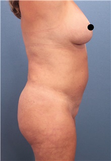 Tummy Tuck Before Photo by Marvin Shienbaum, MD; Brandon, FL - Case 46024