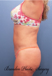 Tummy Tuck After Photo by Marvin Shienbaum, MD; Brandon, FL - Case 46024