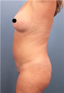 Tummy Tuck Before Photo by Marvin Shienbaum, MD; Brandon, FL - Case 46024