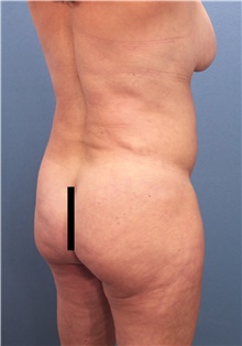 Tummy Tuck Before Photo by Marvin Shienbaum, MD; Brandon, FL - Case 46024