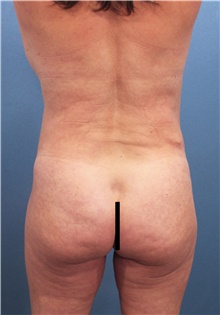 Tummy Tuck Before Photo by Marvin Shienbaum, MD; Brandon, FL - Case 46024