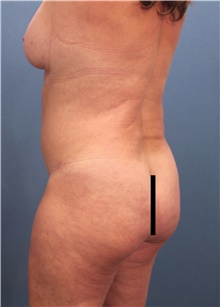 Tummy Tuck Before Photo by Marvin Shienbaum, MD; Brandon, FL - Case 46024