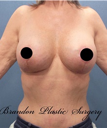 Breast Lift After Photo by Marvin Shienbaum, MD; Brandon, FL - Case 46195