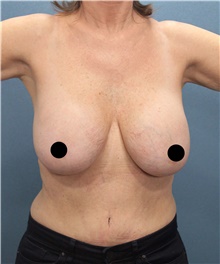 Breast Lift Before Photo by Marvin Shienbaum, MD; Brandon, FL - Case 46195