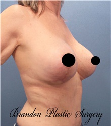 Breast Lift After Photo by Marvin Shienbaum, MD; Brandon, FL - Case 46195