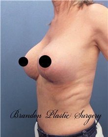 Breast Lift After Photo by Marvin Shienbaum, MD; Brandon, FL - Case 46195