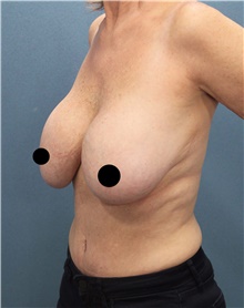 Breast Lift Before Photo by Marvin Shienbaum, MD; Brandon, FL - Case 46195