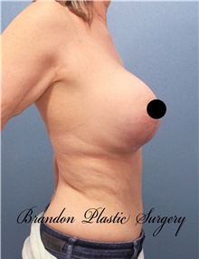 Breast Lift After Photo by Marvin Shienbaum, MD; Brandon, FL - Case 46195