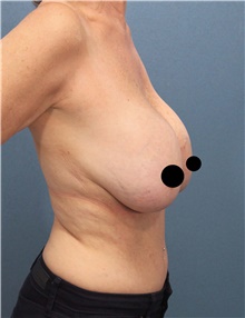 Breast Lift Before Photo by Marvin Shienbaum, MD; Brandon, FL - Case 46195