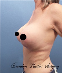 Breast Lift After Photo by Marvin Shienbaum, MD; Brandon, FL - Case 46195