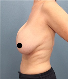 Breast Lift Before Photo by Marvin Shienbaum, MD; Brandon, FL - Case 46195